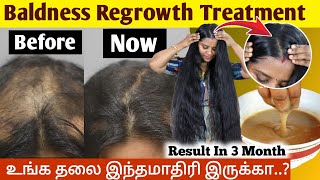 😱It's Possible..!!? இனி வழுக்கை வராது..!! முடி வளர வைக்கலாம்🔥Baldness Hair Growth Treatment