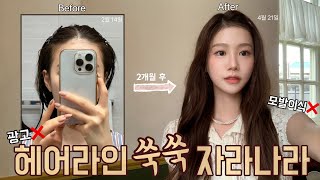 [광고❌] 헤어라인이 빼곡히 자라났어요🪴👧🏻 | Hair loss care | 모발이식 아님 | 탈모 탈출 찐후기 | 리바이탈래쉬 인핸싱 폼 | 두피영양제 | 탈모 관리 꿀팁