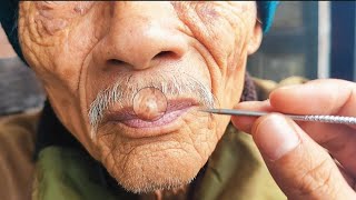 pluck ingrown lips hair for my grandfather asmr