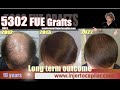 5302FUE Grafts. NW V, 38 yo, med’s: 2 step strategy,10 years outcome. Injertocapilar.com.998/2012