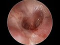 ATELECTASIS OTITIS MEDIA - ENDOSCOPIC TYMPANOPLASTY