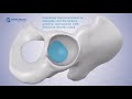 Double Medical Apollo Acetabular Cup System