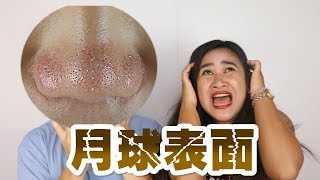 MKUP美咖 【超療癒😭巨大粉刺林大噴發 幫你把它通通大掃除】