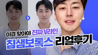 사각턱인데 ⭐침샘보톡스⭐ 아직도 안 맞았다고? 한번에 브이라인 만든 후기😎 l 굿닥몬이 간다