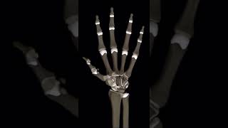 MCP Joint Arthritis | Demonstration #varanasi #orthopaedicdoctor #arthritis #hand