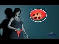 Polycystic ovary syndrome PCOS ( 3d Animation )