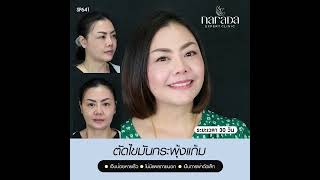 รีวิวผ่าตัดกระพุ้งแก้ม Buccal Fat Removal | by Narada Clinic