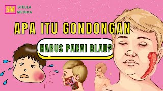 BENARKAH GONDONGAN BISA DISEMBUHKAN DENGAN BLAU?