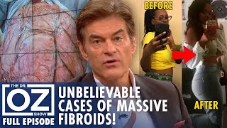 Inside Cases of Massive Fibroids, You Have to See to Believe! | Dr. Oz | S10 | Ep 120 | Full Episode