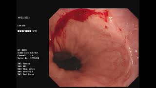 Reflux esophagitis, Esophageal ulcer with bleeding