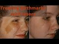 How to treat birthmarks