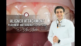 Aligner attachment placement and bonding step by step- aligner delivery -invisalign
