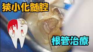 根管内の石灰化【狭窄根幹の見つけ方解説します】