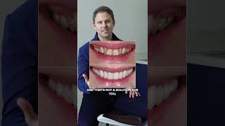 3 Main Reasons People Get Porcelain Veneers