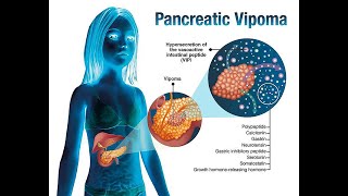 VIPoma pancreatic neuroendocrine tumors secrete excessive amounts of Vasoactive Intestinal Peptide