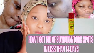 Get Ready With Me On How I Cleared Sunburn/Dark Spots In Less Than 14 Days