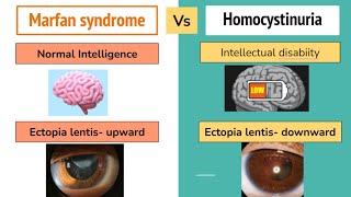 Marfan Syndrome Vs Homocystinuria Mnemonics And High Yield Points For For NEET PG , FMGE