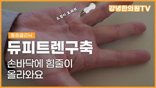 듀피트렌구축. 손바닥힘줄이 피부로 올라와요.