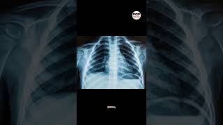 शरीर के लिए कितना घातक हो सकता है X-Ray करवाना?How dangerous can an X-ray be for the body?