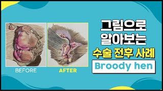 치질 수술 사례 ep 4 : broody hen | 항문질환 수술은 대장항문외과에서! | 서울GS항외과