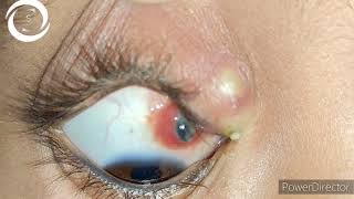 Large Conjunctival FB causing preseptal cellulitis