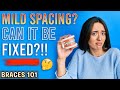 BRACES 101: MILD SPACING w/ Braces?! | Treatment Minute Talk!