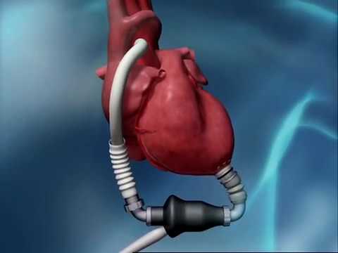 Heartmate Ii Lvad Animation
