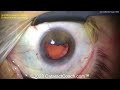 cataractcoach™ 1984 iol scaffold technique