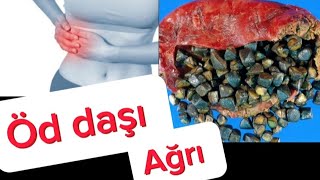 ÖD DAŞI Xəstəliyində ağrılar!!!  Əlmətlər və Müalicə