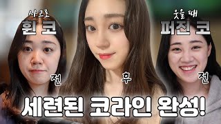 [은비 Vlog] 허??와우!! 자연스럽고 완전 높은 코 성형 | 휜 코, 뭉툭한 코, 낮은 콧대 코 수술로 한 번에 개선🤩🎉 필러 녹이고 상담부터 한 달 차 쿠키 영상까지 [쀼]