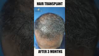 Hair Transplant Before and After Results | Best Hair Transplant Clinic in Chennai | Tamiralife