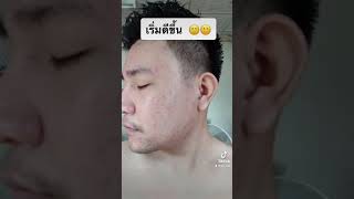 สบู่ไพรเย็น ตัวช่วยเรื่องปาบสิว #รักษาสิว #สบู่ไพรเย็น #สบู่ออแกนิค