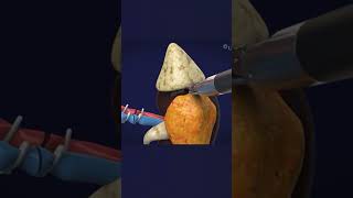 Robotic radical nephrectomy