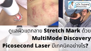 ดูแลผิวแตกลาย Stretch Mark ด้วย MultiMode Discovery Picosecond Laser มีเทคนิคอย่างไร?