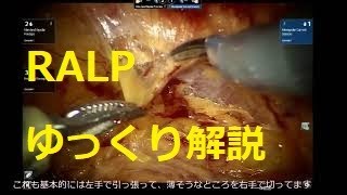 RALP　ゆっくり解説動画①　両側神経温存編　ロボット支援腹腔鏡下前立腺全摘除術