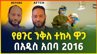 የፀጉር ንቅለ ተከላ ዋጋ በአዲስ አበባ 2016 | Hair transplant price in Addis Ababa | business| gebeya media