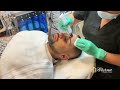 microdermabrasion with hydrafacial