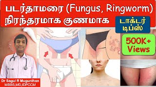 படர்தாமரை முற்றிலும் குணமாக | Home remedies | Foods | How to cure ringworm permanently? | TAMIL