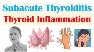 Subacute Thyroiditis (Thyroid Inflammation; De Quervain’s) | Causes, Symptoms, Diagnosis, Treatment