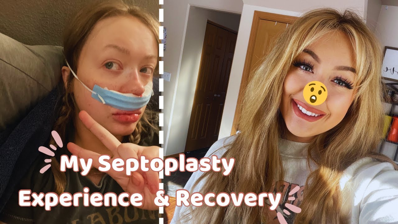 Septoplasty Recovery Blog And Storytime, My Sinus Surgery Experience ...