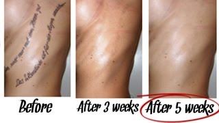 how to remove a tattoo without laser at home how to remove a tattoo without laser at home