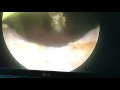 Thulium Laser Incision of The Prostate-Dimitar Mateev M.D. Ph.D.