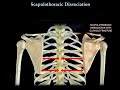 scapulothoracic dissociation a rare traumatic injury with limb and life threatening consequences