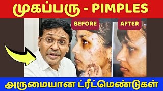 முகப்பரு நீக்கும் அருமையான ட்ரீட்மெண்டுகள்? | how to remove pimples on face at home?