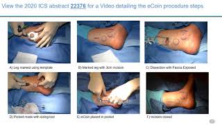 #3 PIVOTAL STUDY OF SUBCUTANEOUS TIBIAL NERVE STIMULATION WITH COIN-SIZED IMPLANTABLE TIBIAL NEU...