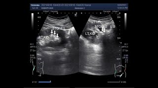 Ectopic kidney with two ureteral stones.