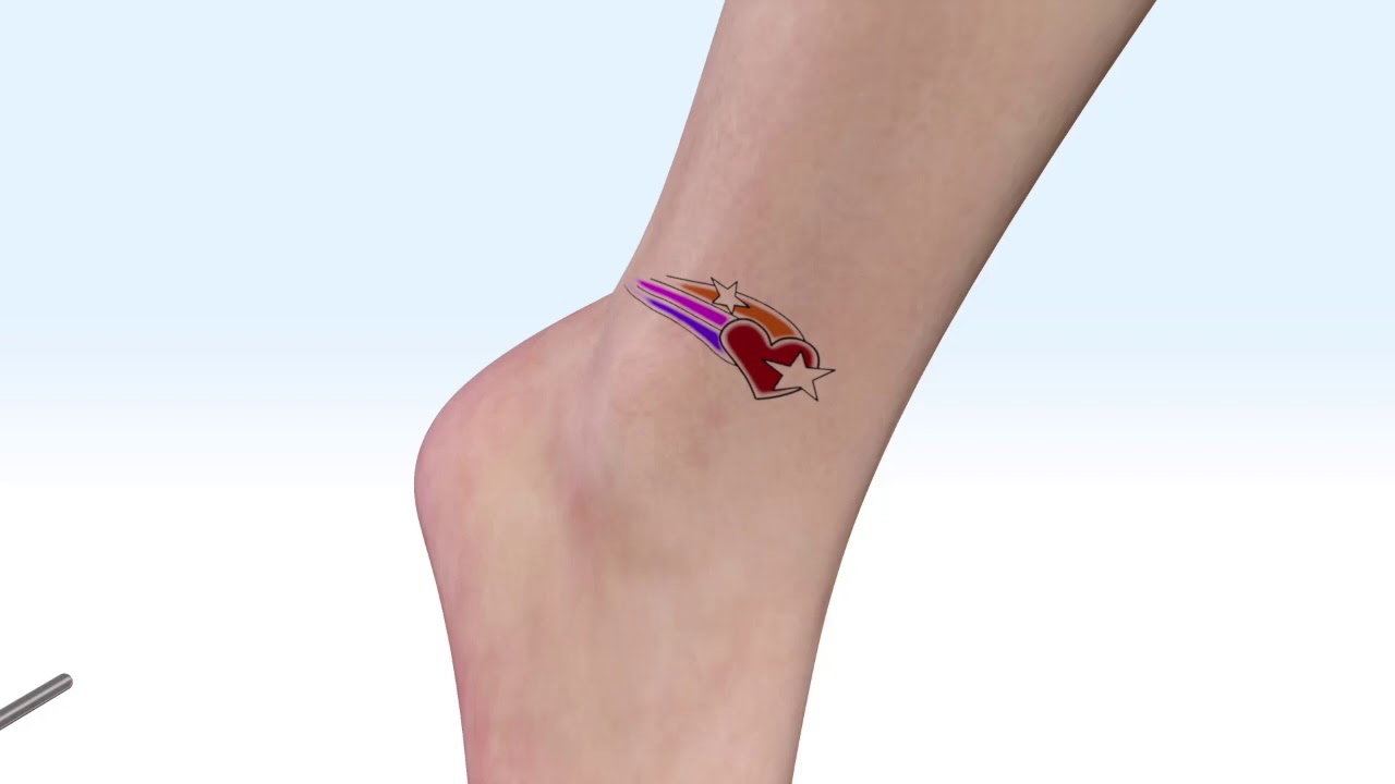 Astanza Duality High Powered Tattoo Removal Laser Youtube