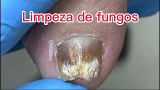 Esse é mais um tipo de fungo nas unhas , a unha fica tipo madeira é micose