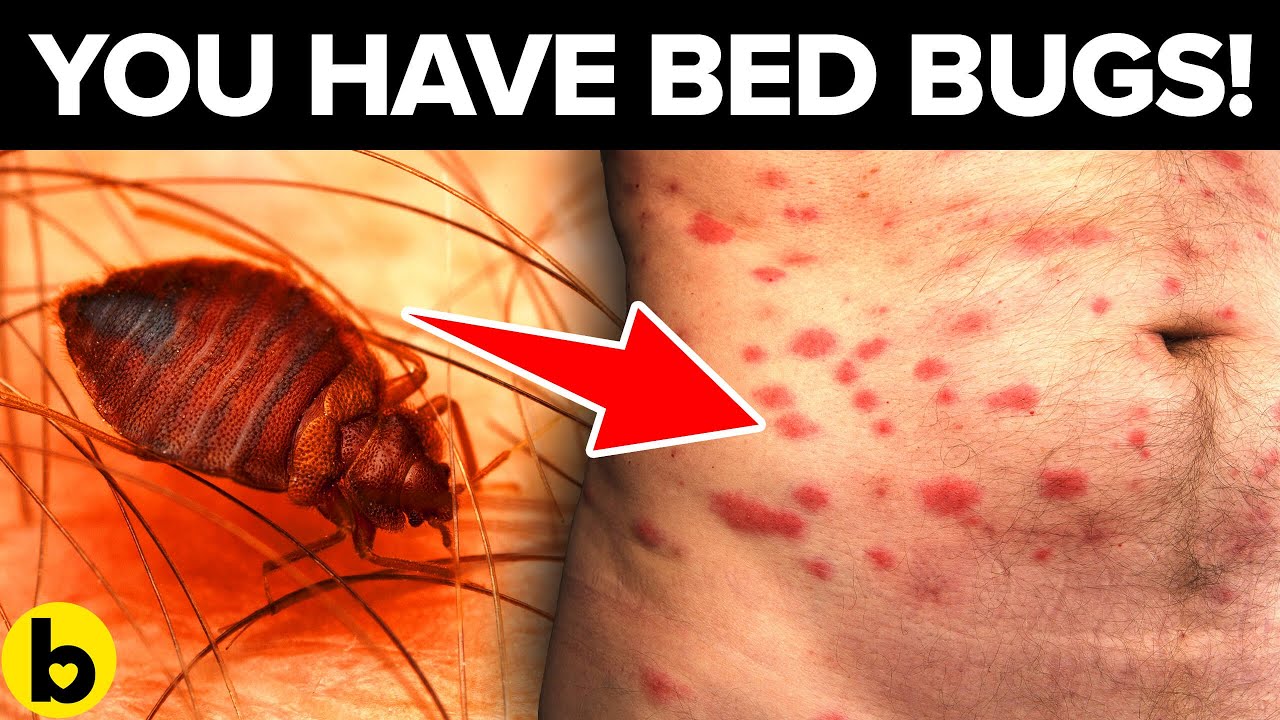 Rash Or Bite? Warning Signs You May Have Bed Bugs - YouTube