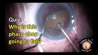 Cataract Quiz: Why is this phaco chop going to fail?